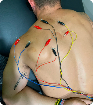 Dry Needling 3